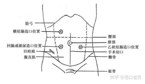 灶口|浅谈造口的类型和定位